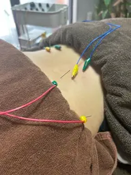 【初回時特別提供】鍼施術