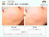 🌟大人ニキビケア・毛穴🌟角質除去60分　¥12,100→¥6,600