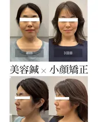 【究極の小顔を目指したい方】小顔矯正+美容鍼 カウンセリング込90分 16500円▶︎8800円