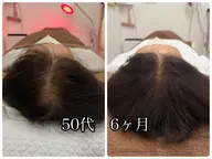 はりひろし式鬼育毛鍼/ＡＧＡ/ＦＡＧＡ/多発性円形脱毛症など