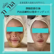 【美容施術前&後】フェイスライン・むくみ・こわばりを丁寧にケアする高周波お顔/顎下/首/デコルテ◎60分集中コース