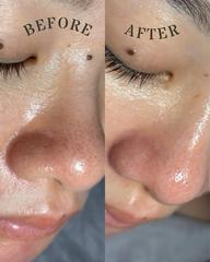 【ミニモ限定】人気NO.1💫💫小鼻の黒ずみ+角質+毛穴開きが気になる方◎デコルテ・肩首オイルケア付き