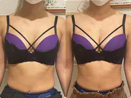 ワキのハミ肉スッキリ☕🤎3D美乳バストデビュー🍩育乳マッサージによるふっくらバスト!背中美人/背中ラインケア