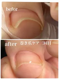 ヘイスッチによる巻き爪ケア