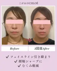 ⭐️小顔矯正モニター様募集⭐️こちらのメニューは目隠しアリの顔出しでオッケーです🙆‍♀️