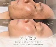 【10月限定】DTあり/話題のシミケア☆導入モデル10分コース