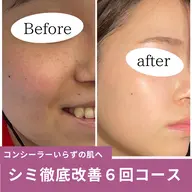 IPL光フェイシャル《6回券》毛穴・くすみ・赤みケア/透明感UP✨