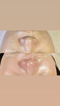 【人気NO2!】自分史上最高のツヤ肌に毛穴洗浄×剥離なしハーブピーリング×WAX脱毛│毛穴悩み/ニキビ/ニキビ跡/くすみ