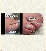 ネイルケア・巻き爪ケア👣