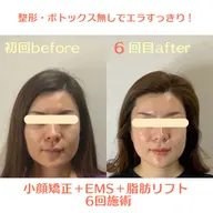 ⭐️劇的小顔リフト💆♀️(韓国超音波×EMS×小顔矯正)小顔マッサージ/フェイシャルエステ/コルギ/リンパマッサージ