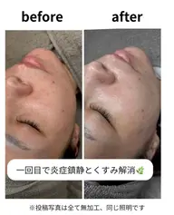 エステダーマ💉気になる肌荒れ💭ニキビを鎮静🌿メンズ◎