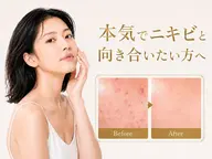 【肌質改善/本気のニキビケアに☆】プラズマ×剥離ありのハーブピーリング