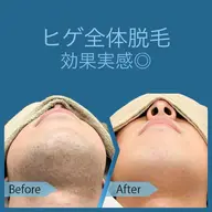 【最新脱毛器!パワー値MAX】 ヒゲ全体脱毛