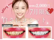 【7月限定🌟エリア最安値!!】強力セルフホワイトニング30分初回体験 ¥7980→¥2000