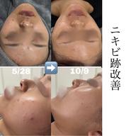 【学生限定🉐】ニキビ・ニキビ跡解決フェイシャル