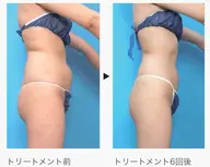 【夏までに楽痩せ】痩身エステ下半身（ヒップから下）コース🫧