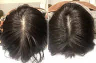 人気①分け目、立ち上がらない髪の毛が気になる方頭皮に鍼で嬉しい変化18,700円▶︎10,000