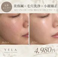 【先着モニター】美容鍼×毛穴洗浄×小顔矯正 4,980円