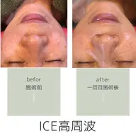 高周波ICE フェイシャル