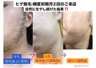 【顔脱毛】女性が気になる口周りも！男性はマナー＆新常識に！