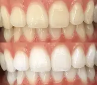 🦷【しっかり白く】プラチナホワイトニング