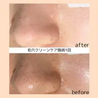 《モニター様※条件有り》毛穴クリーンケア(成長因子パック付)