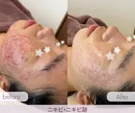 【人気𝐍𝐨.𝟐🥈】剥離ありで効果大🌿🇰🇷韓国式ハーブピーリング✨上質スピキュールで肌再生《凸凹肌・ニキビ》