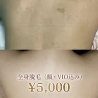 【限定クーポン⭐︎】人気No1👑全身脱毛(顔・VIO込み)¥5,000
