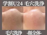 【学割U24】学生限定　黒ずみ角栓ごっそり　毛穴洗浄（顔全体）