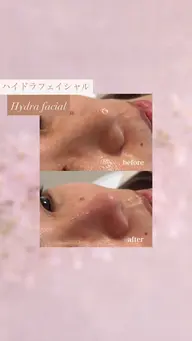 【ニキビ予防に👌🏻】お顔まるごと毛穴洗浄😶‍🌫️💫 口コミ価格🙇🏻‍♀️