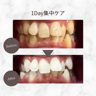 【最短で白くしたい方】1Day集中ケアホワイトニング 9分×6回照射