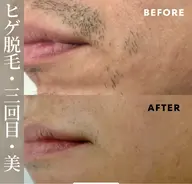 両足・両腕・顔・ヒゲ・胴体・ワキ・VIOどれか1パーツ