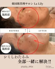 韓国式無針水光施術ミコステラ＋毛穴洗浄