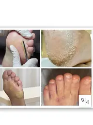 メンズ🆗素足の季節の前に！トータルフットケア（爪周り・かかとの角質、たこ、ウオノメ）【エンザイム角質ビットケア®︎】