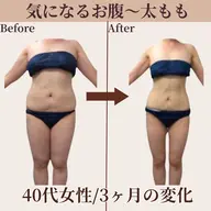 【中胴体☆痩身】着たい服を着こなす♪スッキリボディライン◎悩み深いお腹/お尻/太もも/前ハリに★《初回限定💫特別価格》