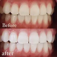 🦷基本セルフホワイトニングコース🦷【8分×2】