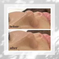 1日1名【いちご鼻/黒ずみから卒業したい方限定】Tゾーン毛穴洗浄お試し30分