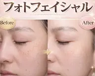 シミ・美白【光フォト美顔+シェービング+保湿うるつやパック付★】¥4980