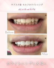【 オープン記念✨４月14.15.16限定】セルフホワイトニング【9 分×2 回】 ¥500 別途料金なし
