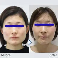 👑全国人気NO.1！👑【小顔矯正+美顔マッサージ】+【首肩矯正】💆 50分＜顔やせ/エラ張り/首を長く細くなど＞