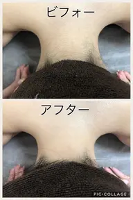 夏場にむけて、全身ツルツル美肌に✨「全身脱毛パーフェクトプラン(顔・vioあり)」2回目以降