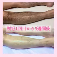 ❣キャンペーン中🌸次回予約で2回目も初回価格🌸メンズ脱毛】👨✨選べる膝下 or 肘下脱毛🔥薄くしたい方も❣