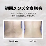 👨🏻初回メンズ脱毛👨🏻全身脱毛(顔、VIO含まない)🍀特別価格🍀