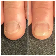 即日美爪形成コース　　　　　　　　　　　　　　　　　　　たった3時間で変わる深爪矯正