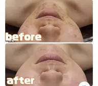 ✨韓国女優肌ピーリング🩵ニキビ&毛穴の黒ずみをケアで驚きの水光肌へ🩵