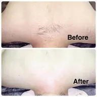 【背中上部ミックス脱毛】産毛やザラつきを整えなめらかな背中に✨【シュガーリング×光脱毛】