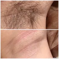 minimo限定価格🧡脇ダブル脱毛