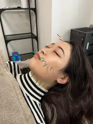 美容鍼・顔面鍼