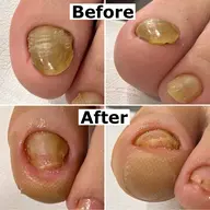 【急募】セミナー無料モデル募集❣️巻き爪、変形・肥厚爪、うおの目、タコでお悩みの方🦶メニュー詳細をご覧ください😊