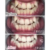 【結婚式・前撮り】プレミアムホワイトニング💁‍♀️<合計80分照射2来店>